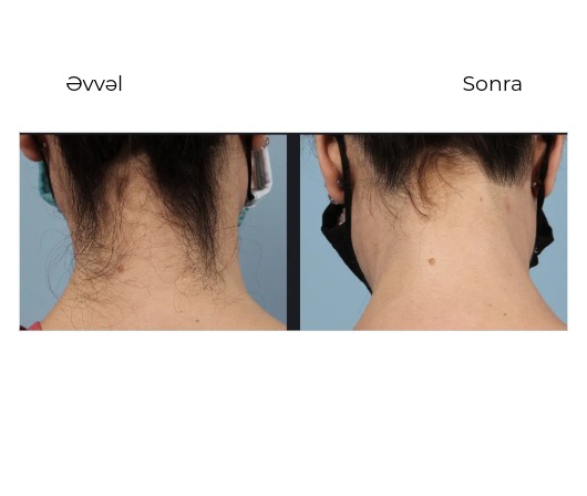 Candela GentleMax Pro